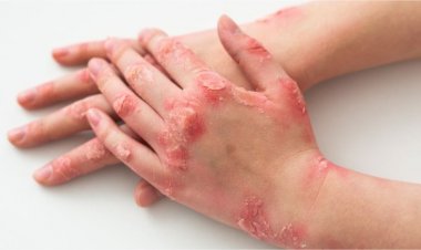 Nuevo consultorio de Psoriasis en el Hospital Rawson