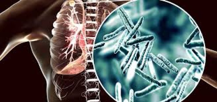 Aumentaron un 38% los casos de tuberculosis en Argentina