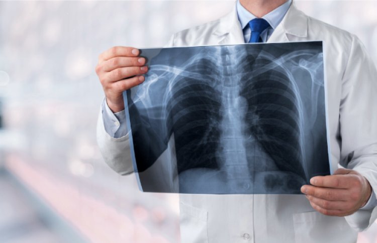 Día Mundial del Cáncer de Pulmón: alertan sobre el aumento de casos