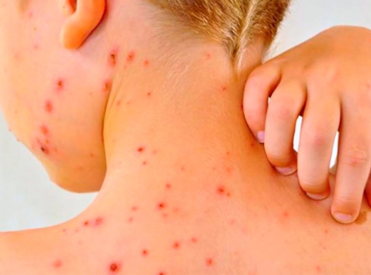 Alerta epidemiológica por nuevos casos de sarampión