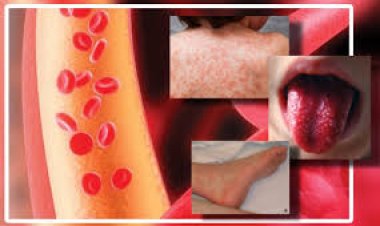 Enfermedad de Kawasaki: qué es y a quiénes afecta