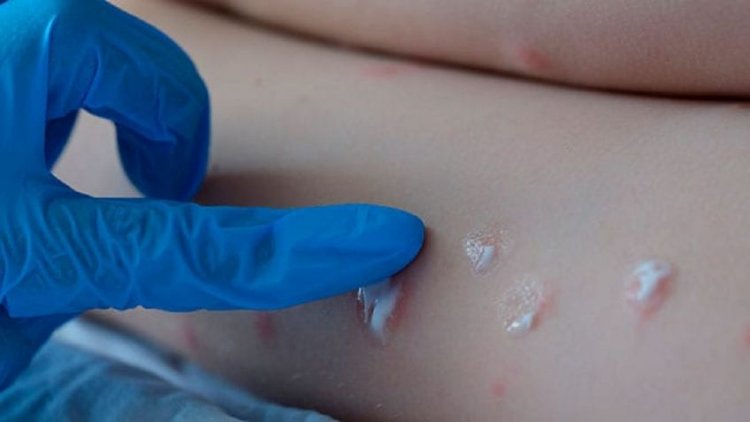 Confirmaron el primer caso de viruela del mono en Argentina