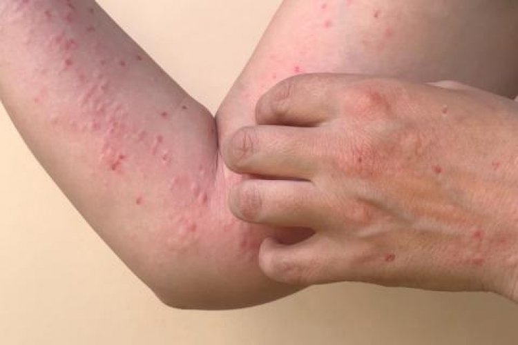 Viruela del Mono:  2 casos sospechosos fueron descartados en  San Juan