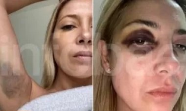 Trascendieron fotos de Fabiola Yañez golpeada tras la denuncia contra Alberto Fernández