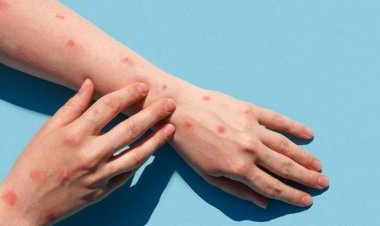 Viruela del mono: cómo se transmite y como prevenir la enfermedad