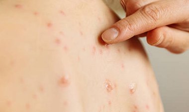 Para la OMS mpox sigue siendo emergencia de salud pública