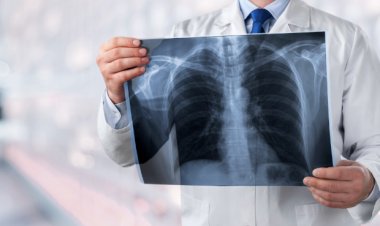 Día Mundial del Cáncer de Pulmón: alertan sobre el aumento de casos