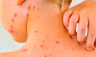 Alerta epidemiológica por nuevos casos de sarampión